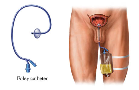 catheter-drawing.jpg